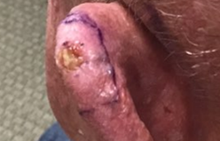 Picture1 GentleCure™ Treatment Before and After Pictures Monroe, LA and Southlake, TX