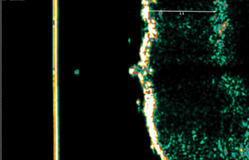 Picture2 GentleCure™ Treatment Before and After Pictures Monroe, LA and Southlake, TX