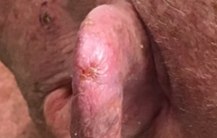 Picture3 GentleCure™ Treatment Before and After Pictures Monroe, LA and Southlake, TX