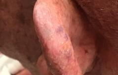 Picture5 GentleCure™ Treatment Before and After Pictures Monroe, LA and Southlake, TX