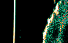 Picture6 GentleCure™ Treatment Before and After Pictures Monroe, LA and Southlake, TX