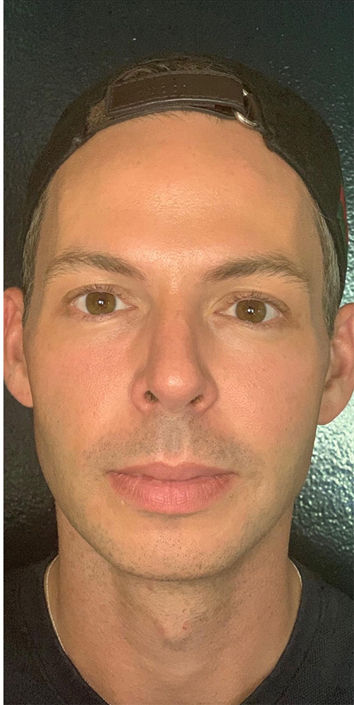 Sculptra® Before and After Pictures Monroe, LA and Southlake, TX