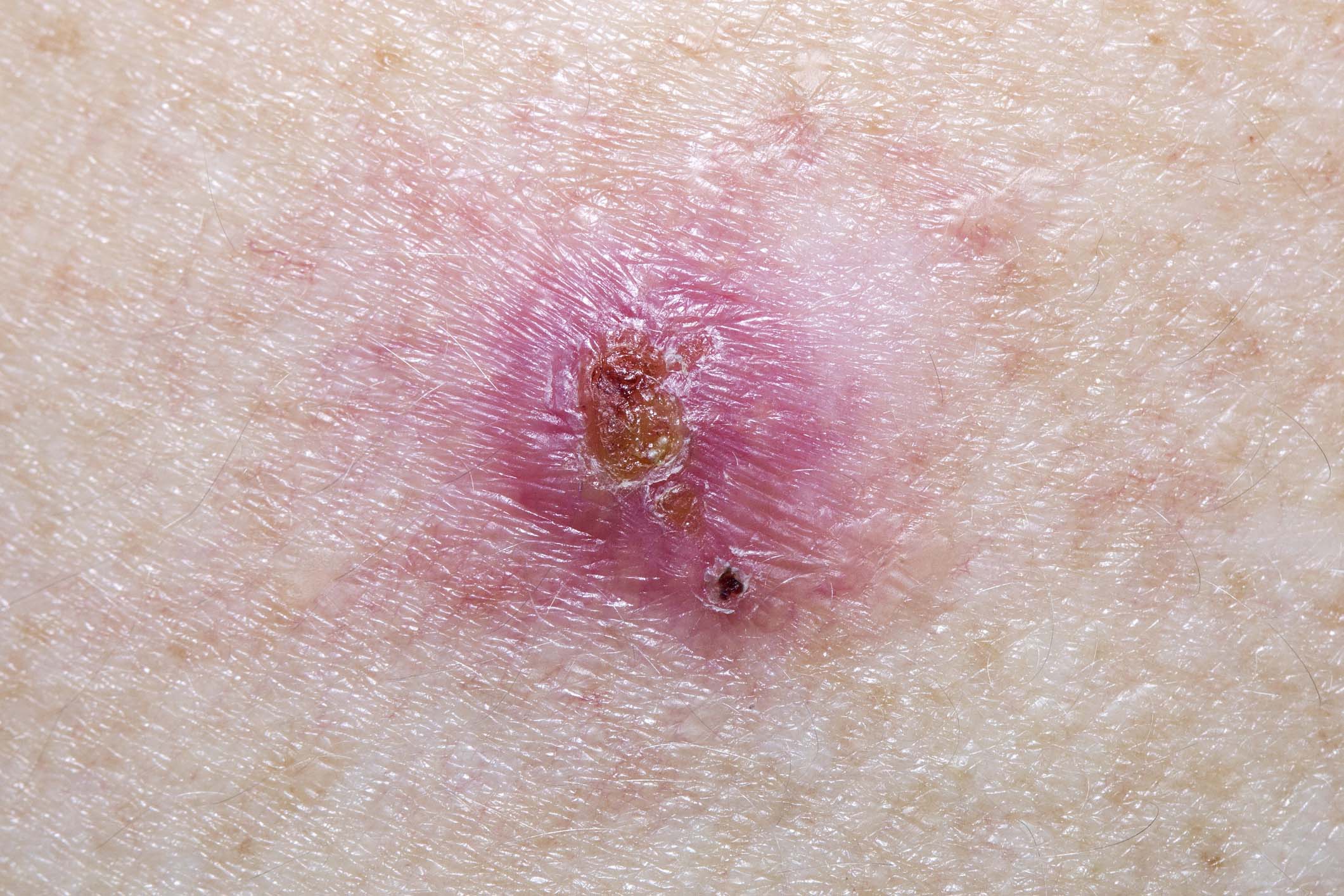 Basal Cell Carcinoma Treatment in Monroe, LA and Southlake, TX