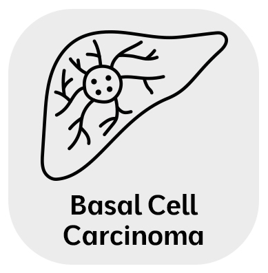 Basal Cell Carcinoma Treatment in Monroe, LA and Southlake, TX