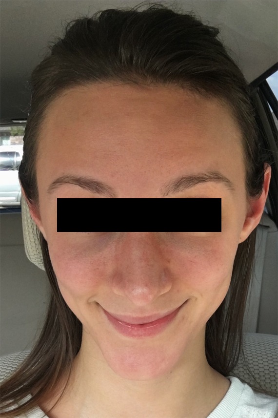Botox® Before and After Pictures Monroe, LA and Southlake, TX