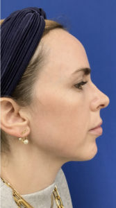 Microlaser HydraFusion Facials Before & After Pictures Monroe, LA and Southlake, TX