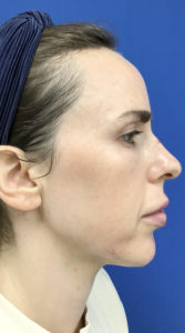 Microlaser HydraFusion Facials Before & After Pictures Monroe, LA and Southlake, TX