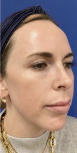 Microlaser HydraFusion Facials Before & After Pictures Monroe, LA and Southlake, TX