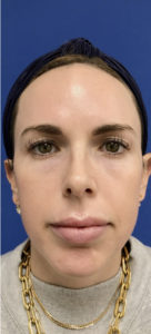 Microlaser HydraFusion Facials Before & After Pictures Monroe, LA and Southlake, TX