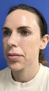 Microlaser HydraFusion Facials Before & After Pictures Monroe, LA and Southlake, TX