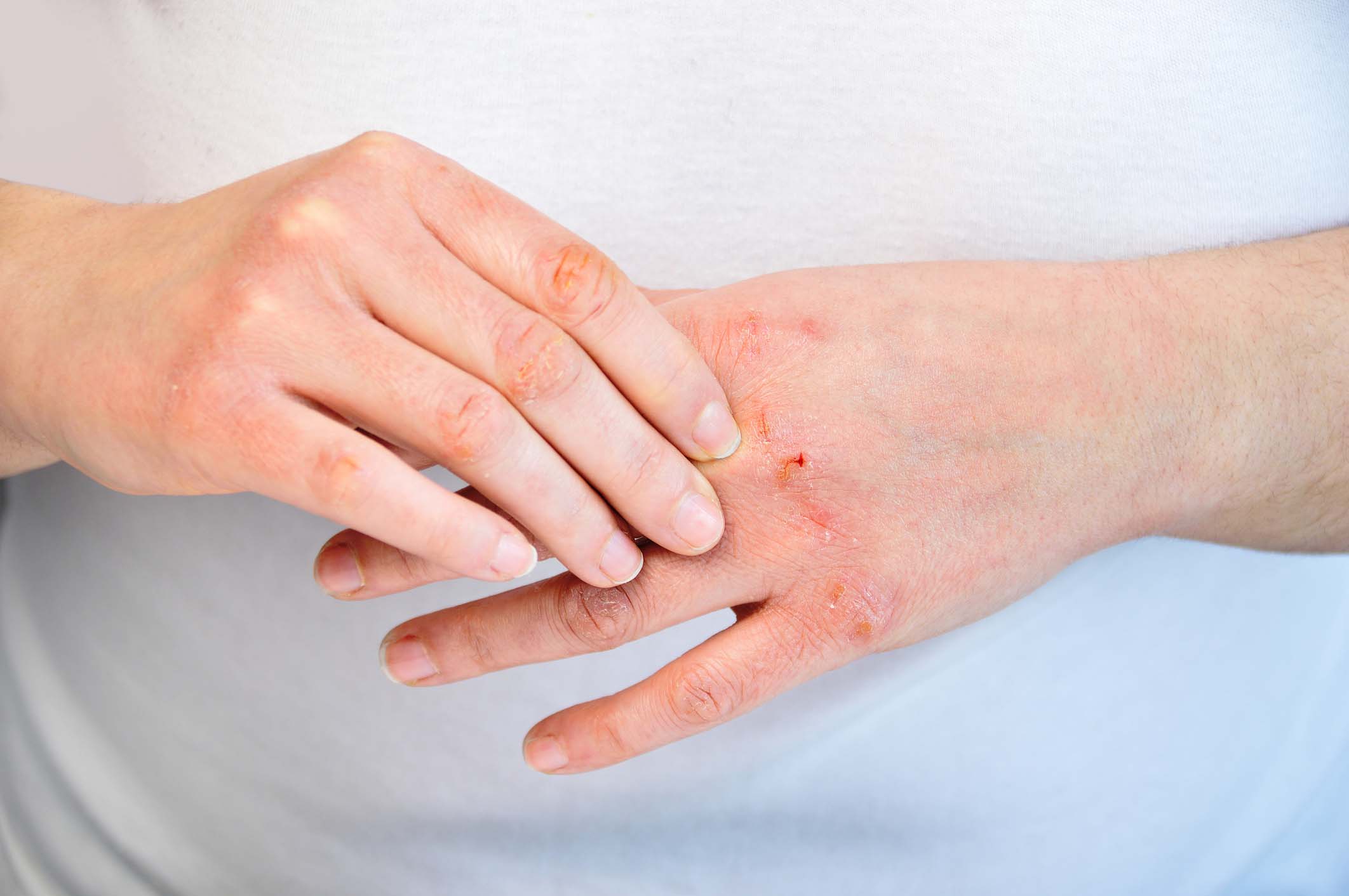 Eczema Treatment in Monroe, LA and Southlake, TX