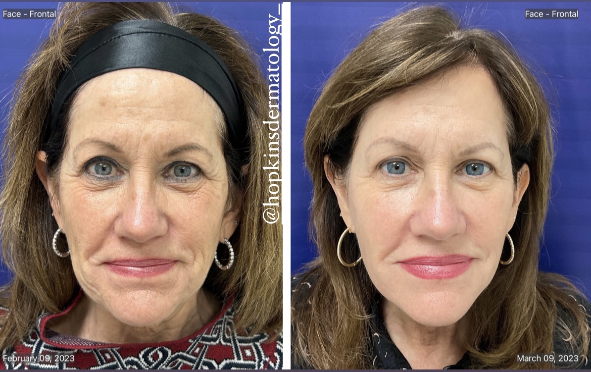 Laser Treatments Before and After Pictures in Monroe, LA and Southlake, TX