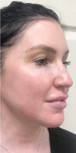 Geneo Facial Before & After Pictures Monroe, LA and Southlake, TX