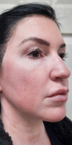 Geneo Facial Before & After Pictures Monroe, LA and Southlake, TX