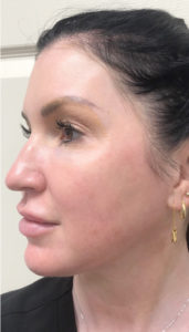 Geneo Facial Before & After Pictures Monroe, LA and Southlake, TX
