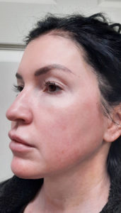 Geneo Facial Before & After Pictures Monroe, LA and Southlake, TX