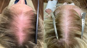 Hair Website Hair Loss Treatment Before and After Pictures Monroe, LA and Southlake, TX