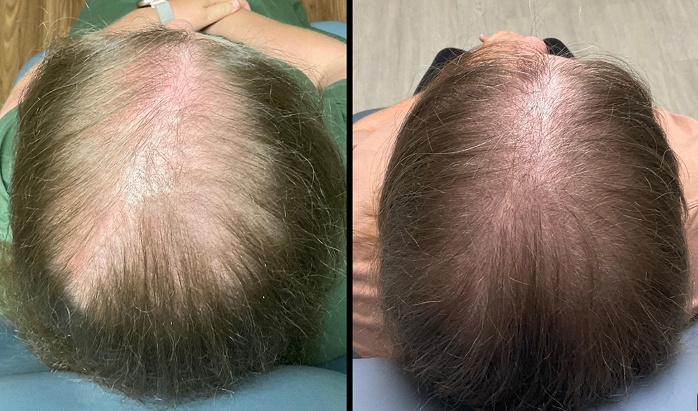 Hair loss treatment 1 Hair Loss Treatment Before and After Pictures Monroe, LA and Southlake, TX