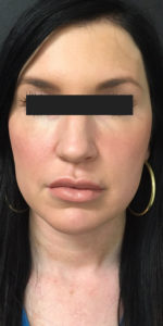 Cosmetic Dermatology Before and After Pictures Monroe, LA and Southlake, TX