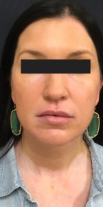 Cosmetic Dermatology Before and After Pictures Monroe, LA and Southlake, TX