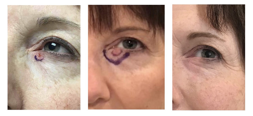 IG-srt before and after Skin Cancer Treatment Before and After Pictures Monroe, LA and Southlake, TX