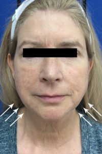 Cosmetic Dermatology Before and After Pictures Monroe, LA and Southlake, TX