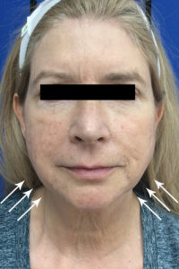 Cosmetic Dermatology Before and After Pictures Monroe, LA and Southlake, TX