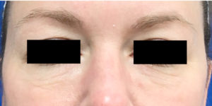 Eyelid Microlaser Filler and Botox Before & After Pictures Monroe, LA and Southlake, TX