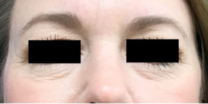 Eyelid Microlaser Filler and Botox Before & After Pictures Monroe, LA and Southlake, TX