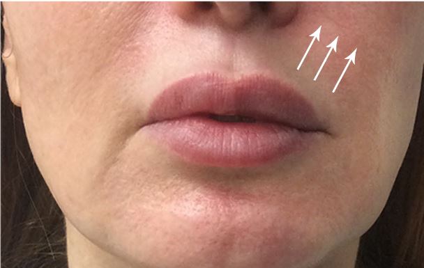 Lip Augmentation with LipLase Before and After Pictures Monroe, LA and Southlake, TX