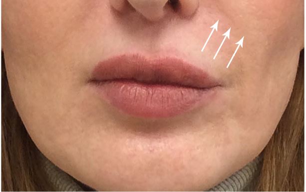 Lip Augmentation with LipLase Before and After Pictures Monroe, LA and Southlake, TX