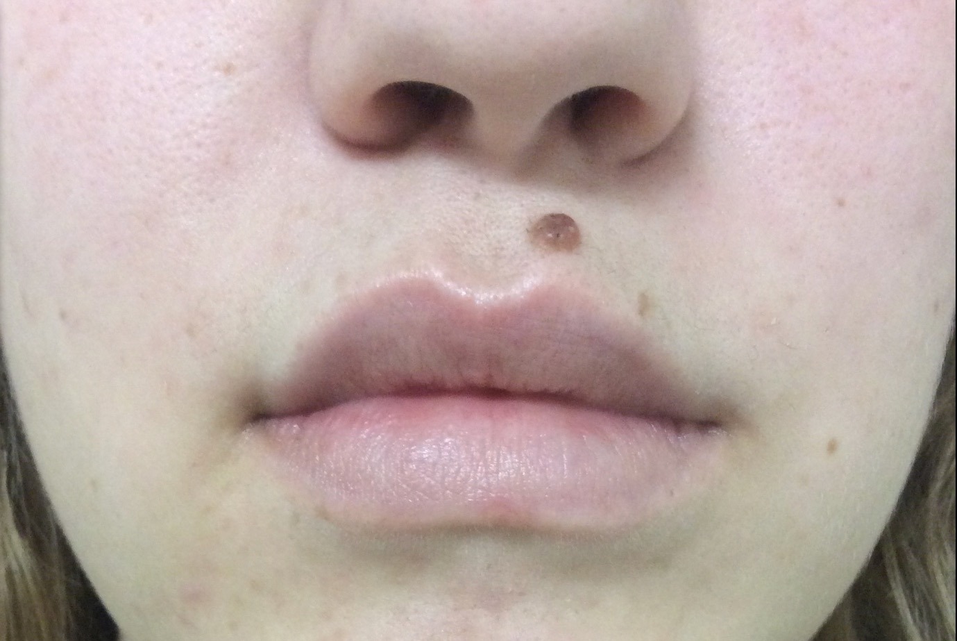 Lip Augmentation with LipLase Before and After Pictures Monroe, LA and Southlake, TX