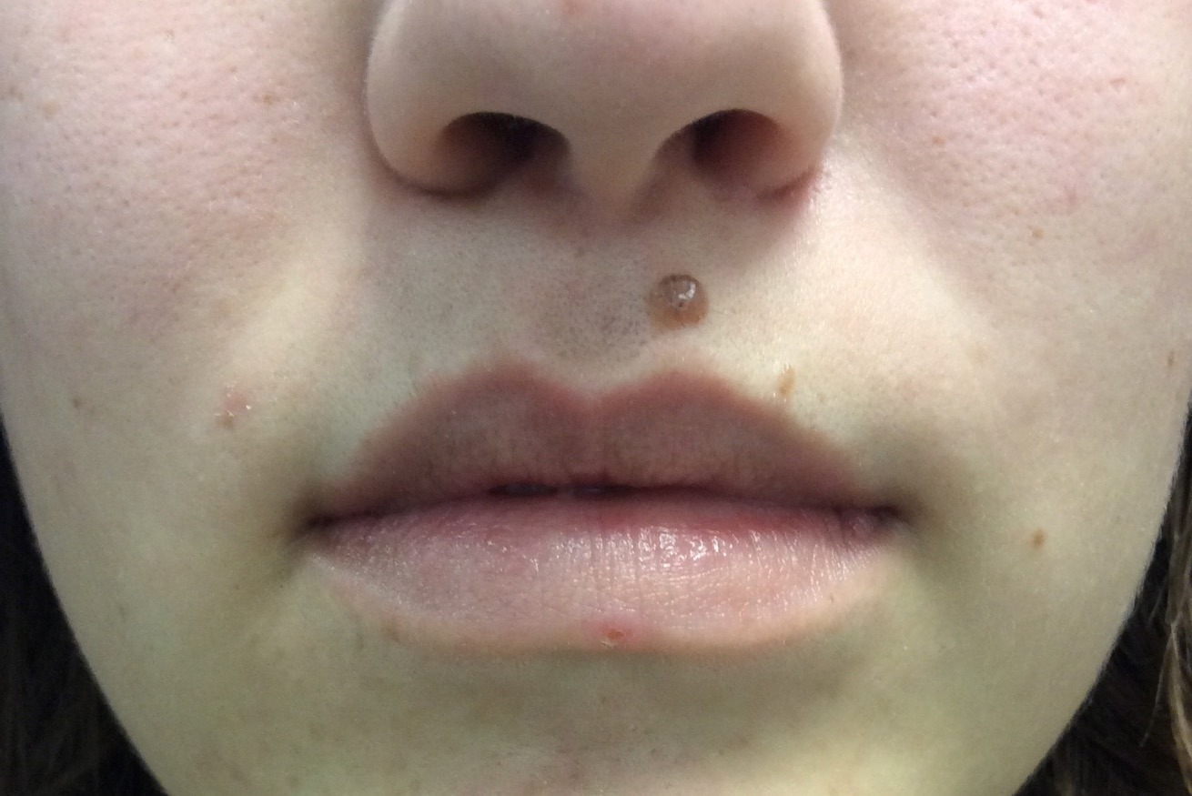 Lip Augmentation with LipLase Before and After Pictures Monroe, LA and Southlake, TX