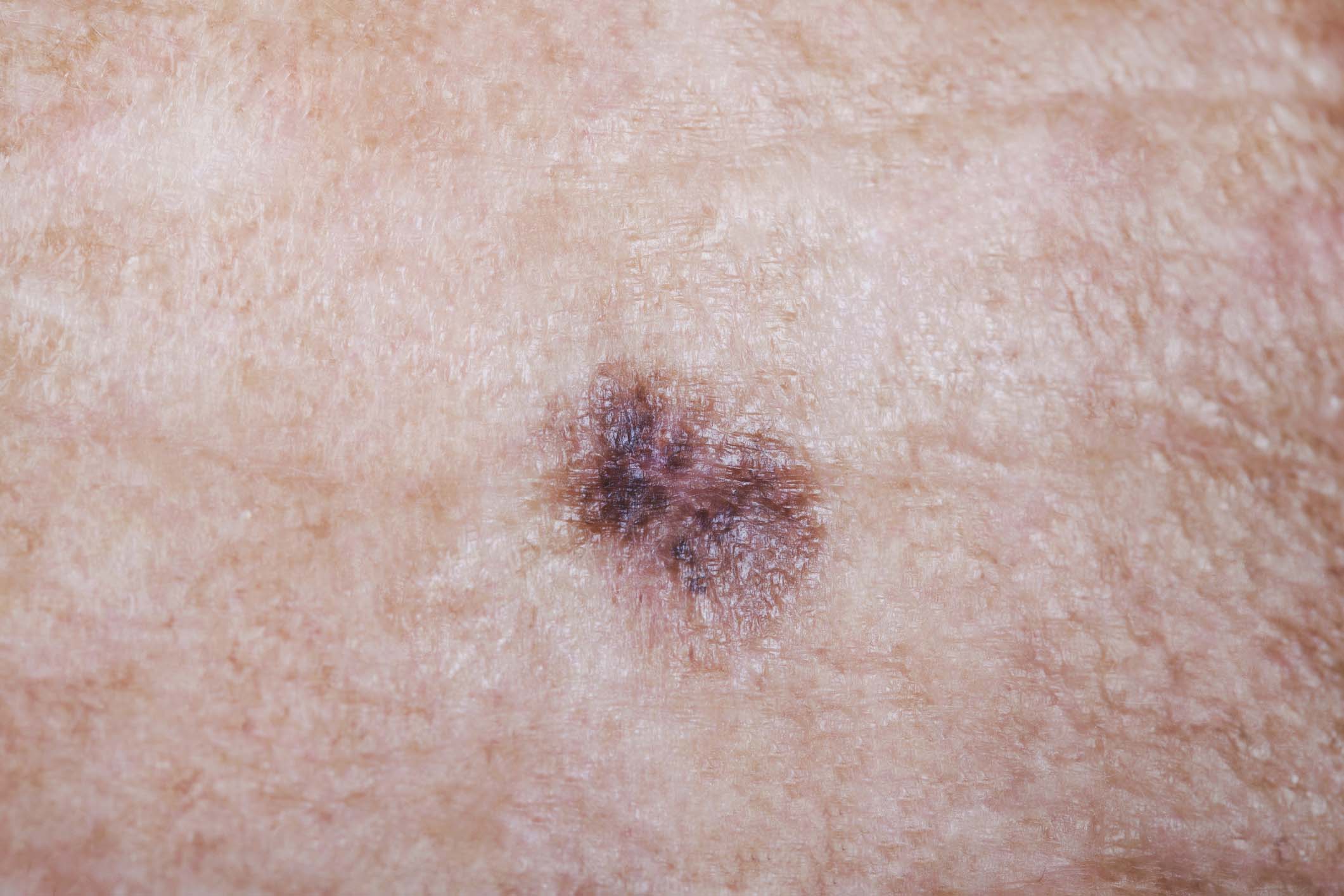 Melanoma in Monroe, LA and Southlake, TX