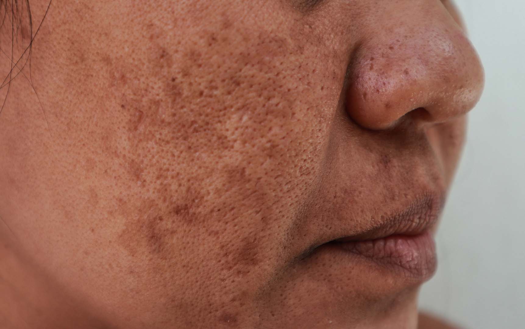 Melasma Treatment in Monroe, LA and Southlake, TX