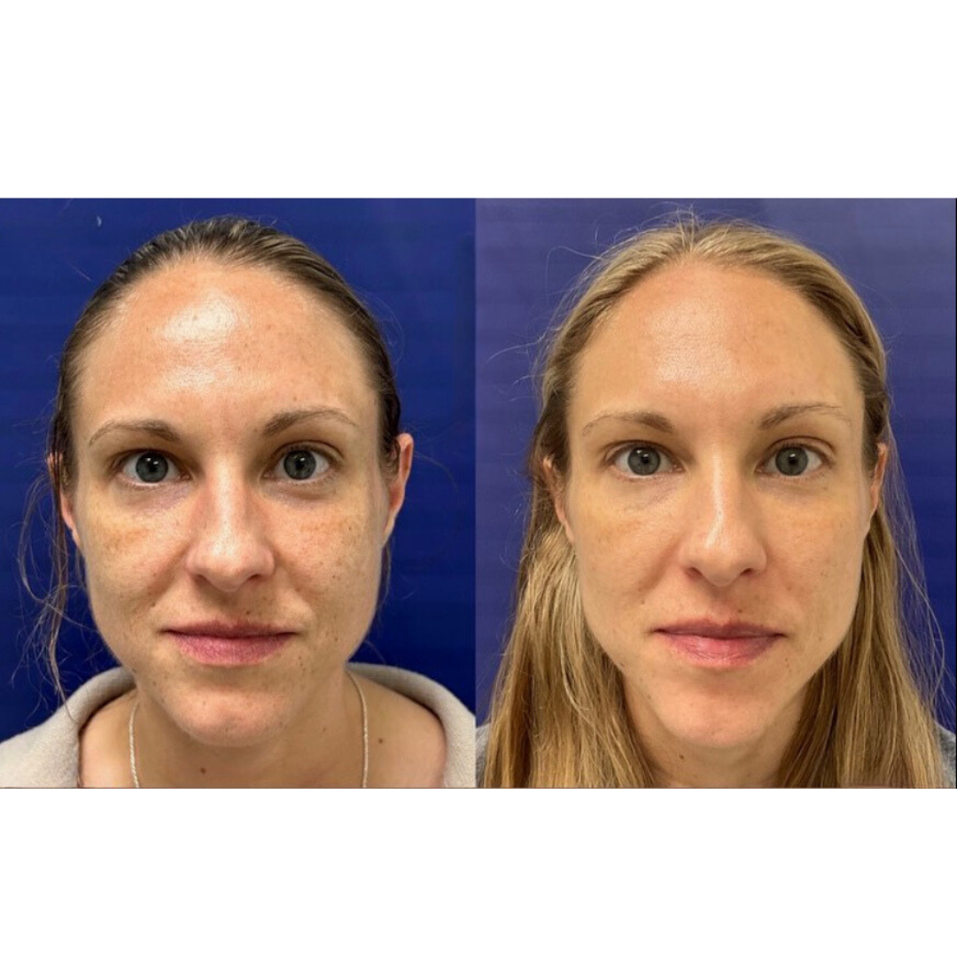 Microneedling Page Microneedling/Microlasering in Monroe, LA and Southlake, TX