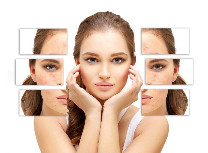 Acne Scar Treatment in Monroe, LA and Southlake, TX