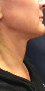 Necklift Before and After Pictures Monroe, LA and Southlake, TX