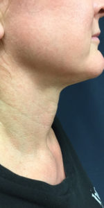 Necklift Before and After Pictures Monroe, LA and Southlake, TX