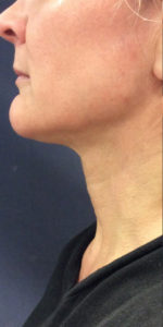 Necklift Before and After Pictures Monroe, LA and Southlake, TX