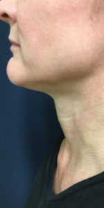 Necklift Before and After Pictures Monroe, LA and Southlake, TX