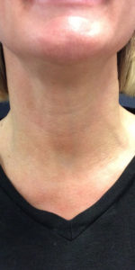Necklift Before and After Pictures Monroe, LA and Southlake, TX