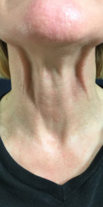 Necklift Before and After Pictures Monroe, LA and Southlake, TX