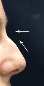 Nose Filler Before and After Pictures Monroe, LA and Southlake, TX