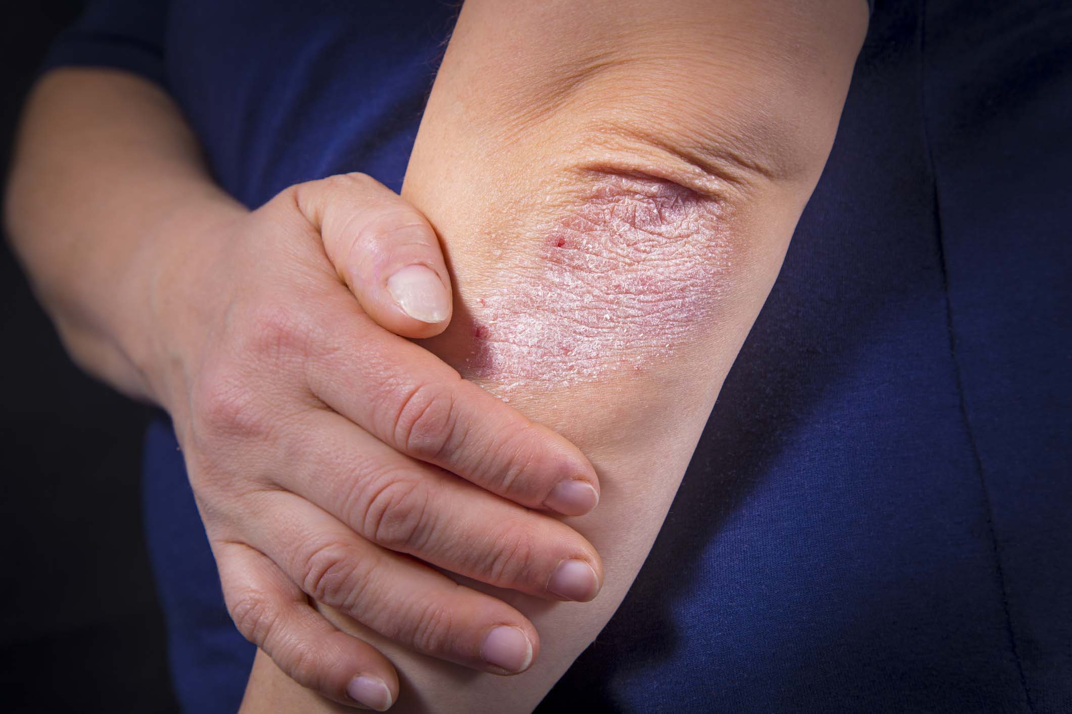 Psoriasis Treatment in Monroe, LA and Southlake, TX