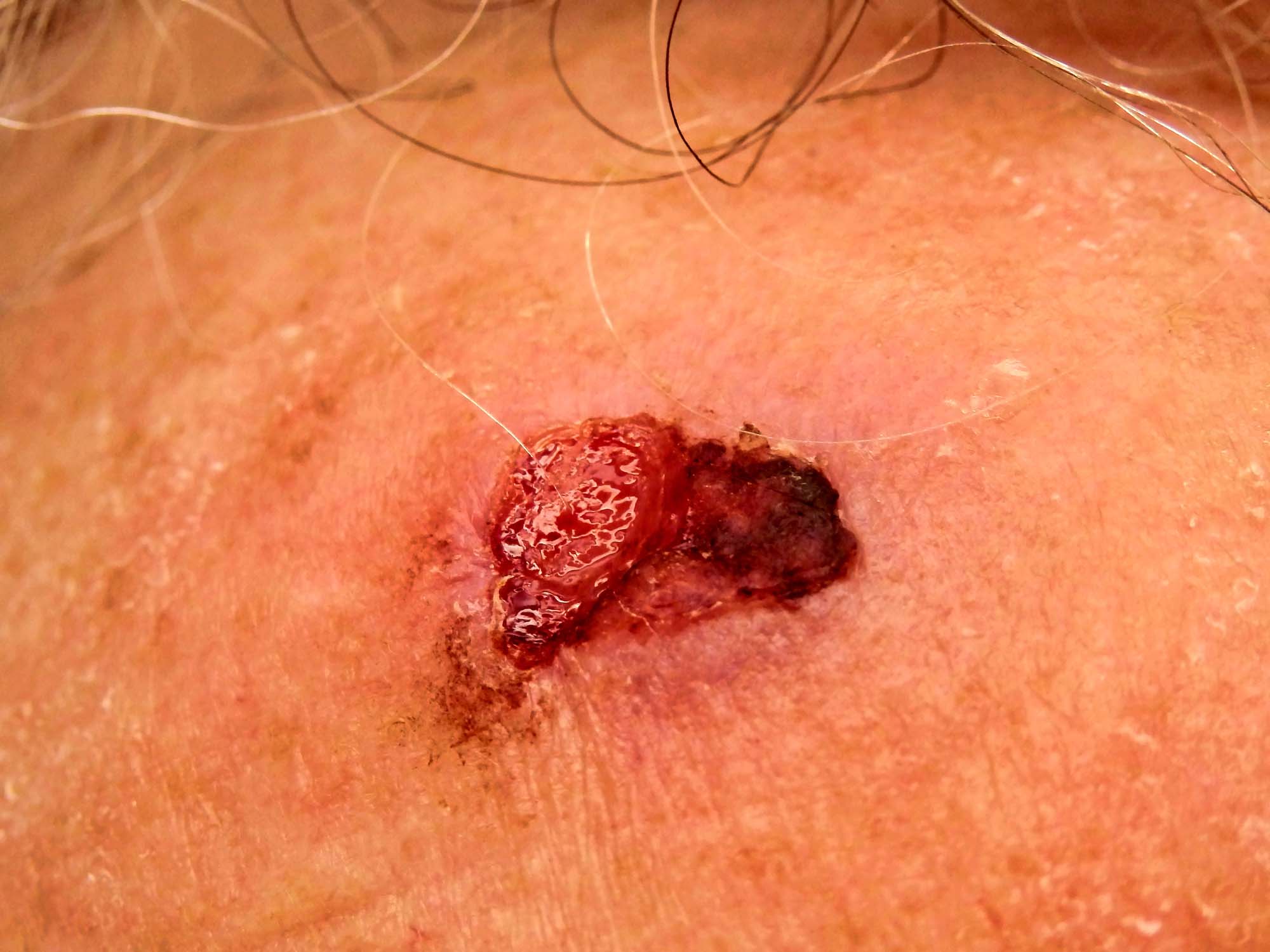 Squamous Cell Carcinoma Treatment in Monroe, LA and Southlake, TX