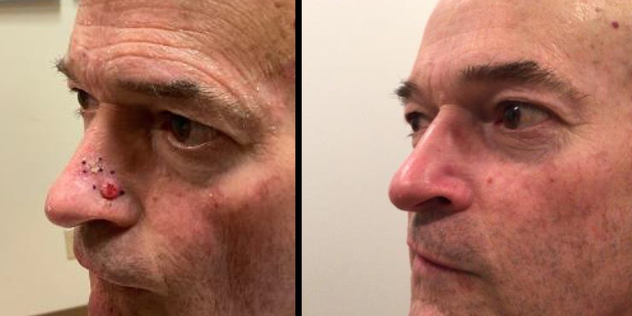 Squamous Cell Carcinoma Treatment in Monroe, LA and Southlake, TX