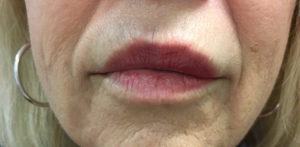 Cosmetic Dermatology Before and After Pictures Monroe, LA and Southlake, TX