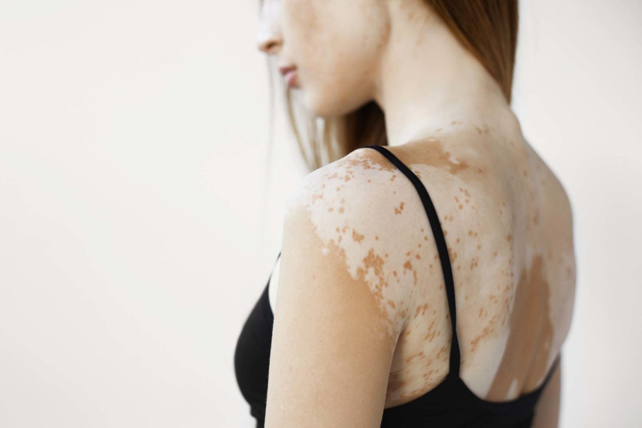 Vitiligo Treatment Monroe, LA | Southlake, TX Vitiligo Treatment