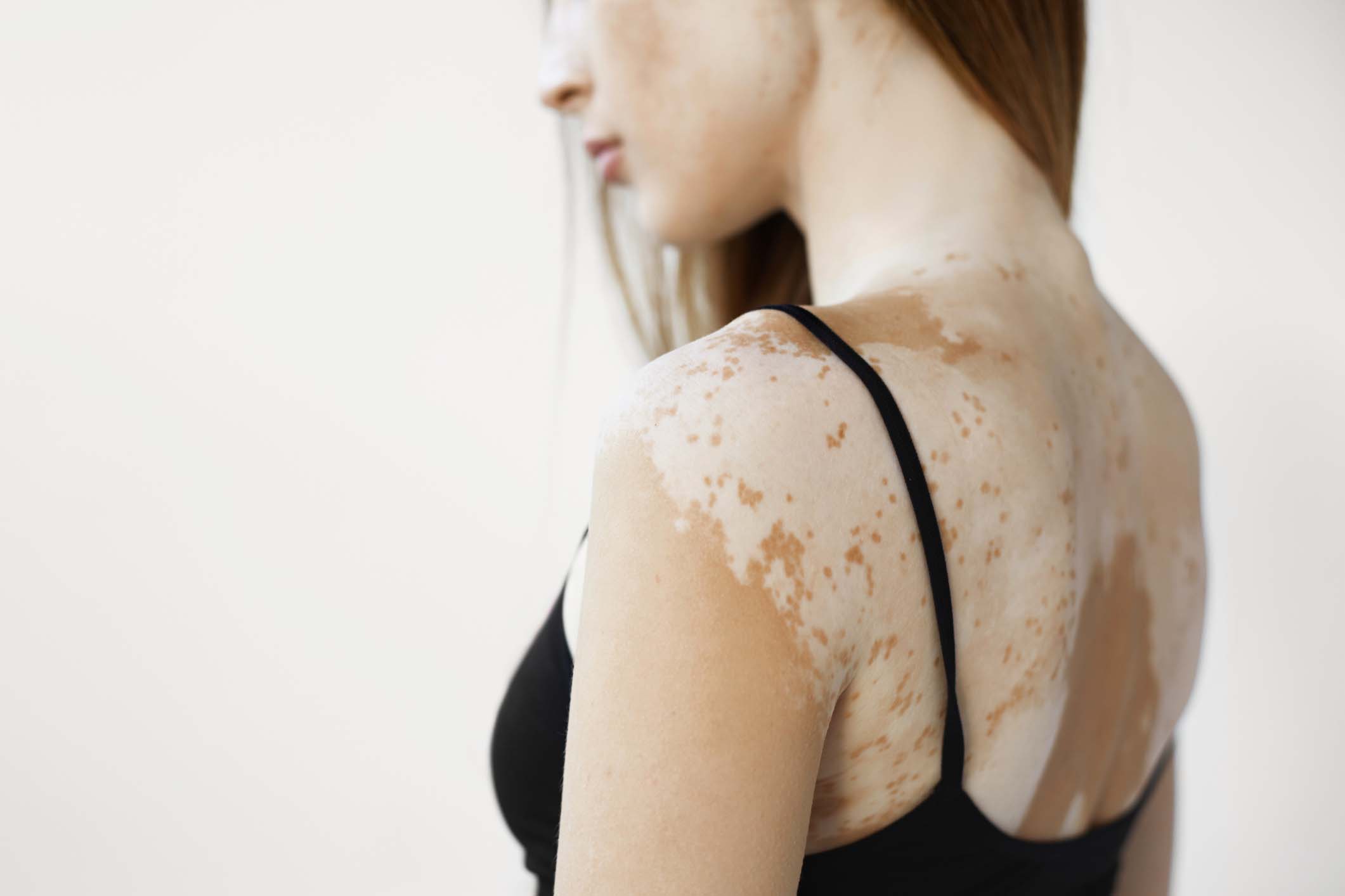 Vitiligo Treatment in Monroe, LA and Southlake, TX